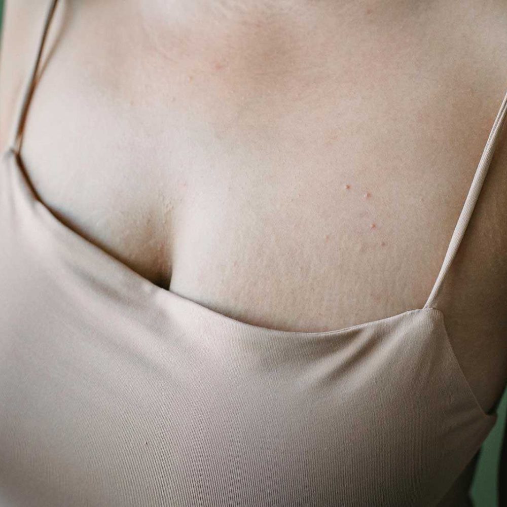 Breast surgery scar management  - breast augmentation