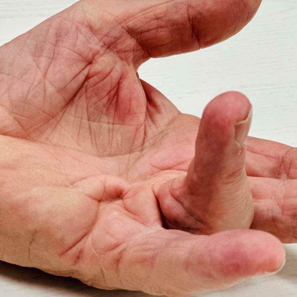 Hand with Dupuytren contracture or vikings disease