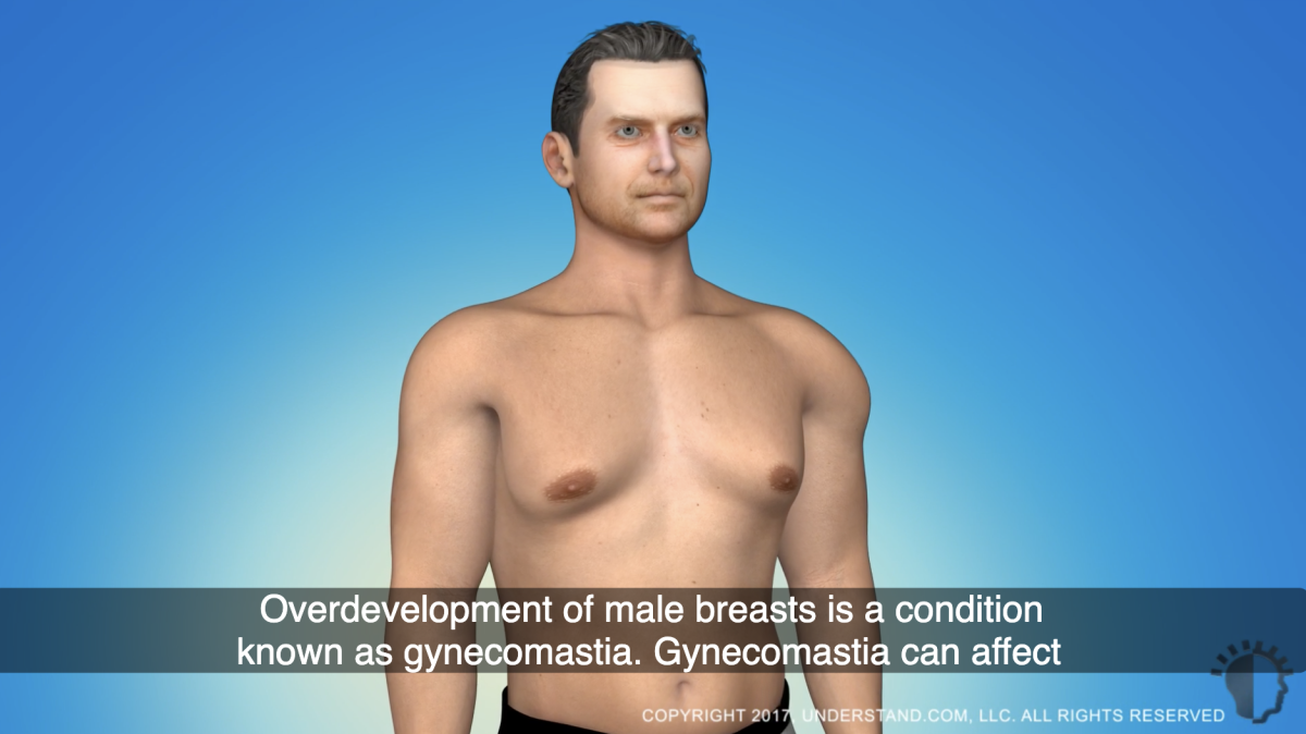 Gynecomastia surgery Adelaide Men’s Breast Reduction video