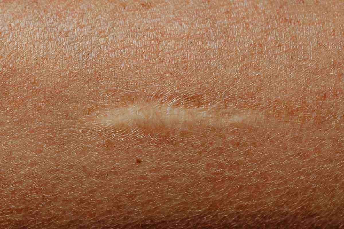 A scar after breast surgery