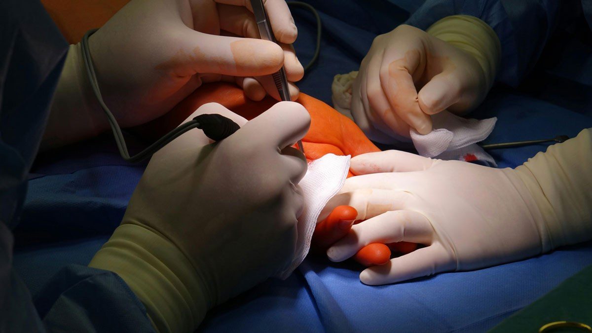 Adelaide Hand Surgeon operating on Vikings disease or dupuytren contracture